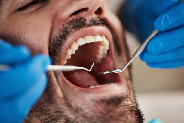 Best Emergency Dentist for Lost Fillings or Crowns in Athena, OR